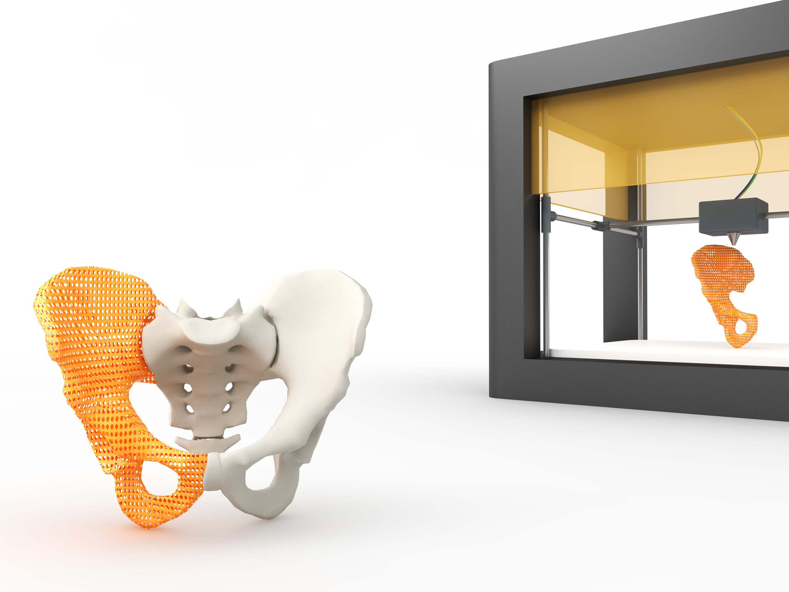 3D printing broken hip bone piece